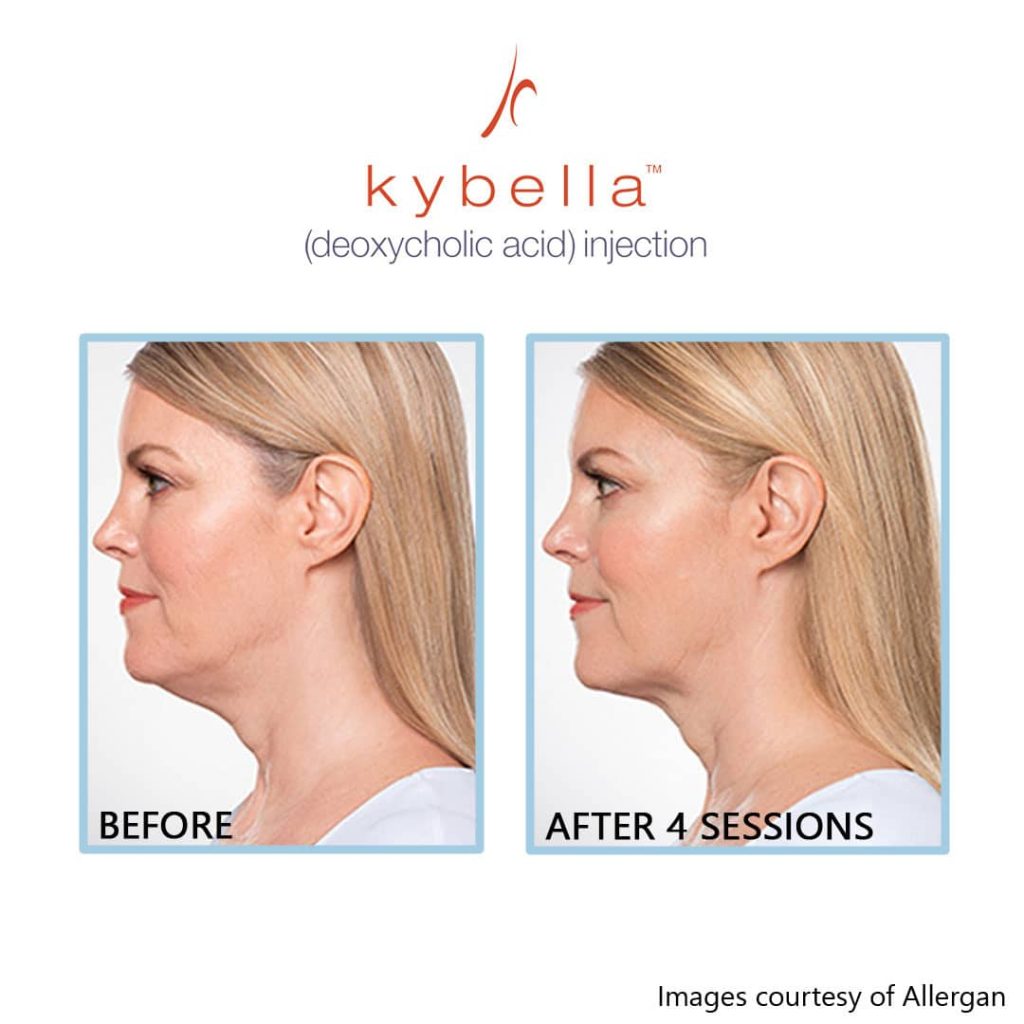 Kybella double chin treatment before and after 4 sessions