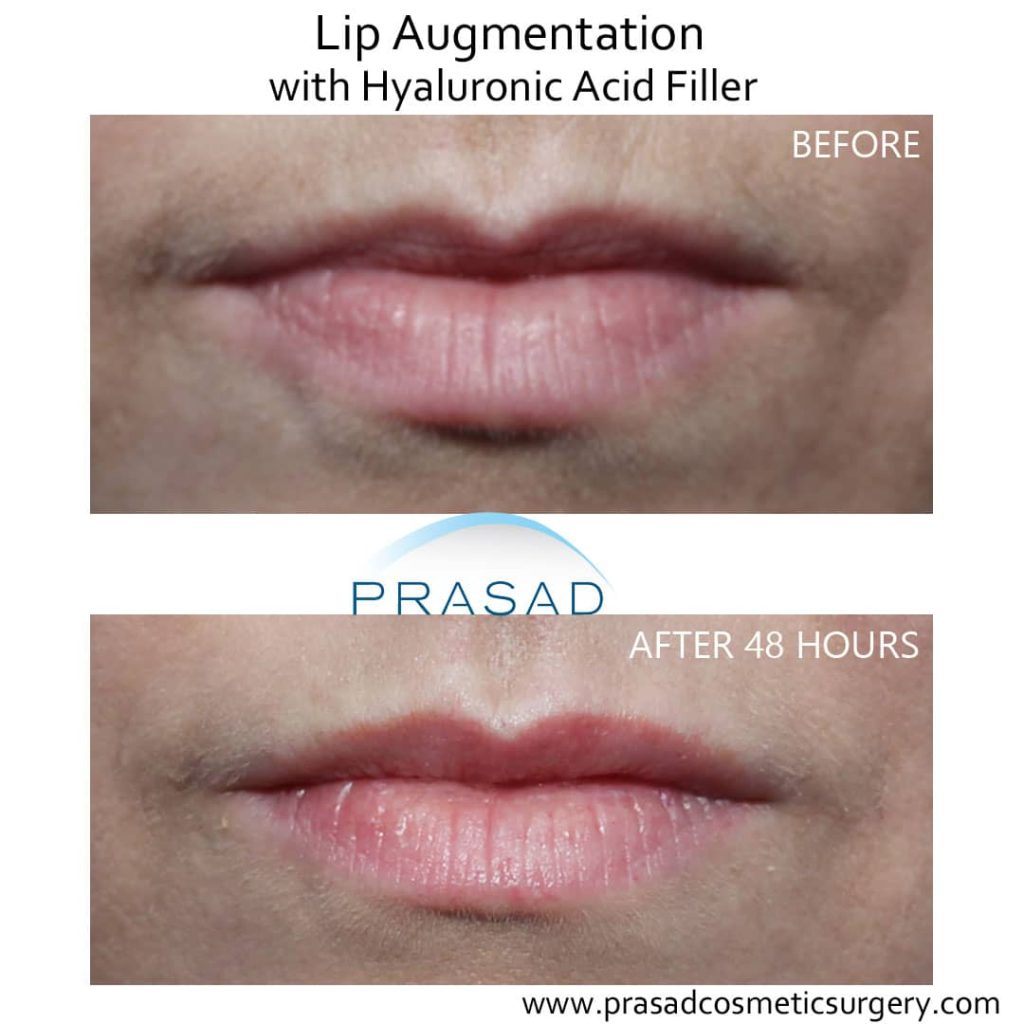 before and day 2 after lip filler no bruising