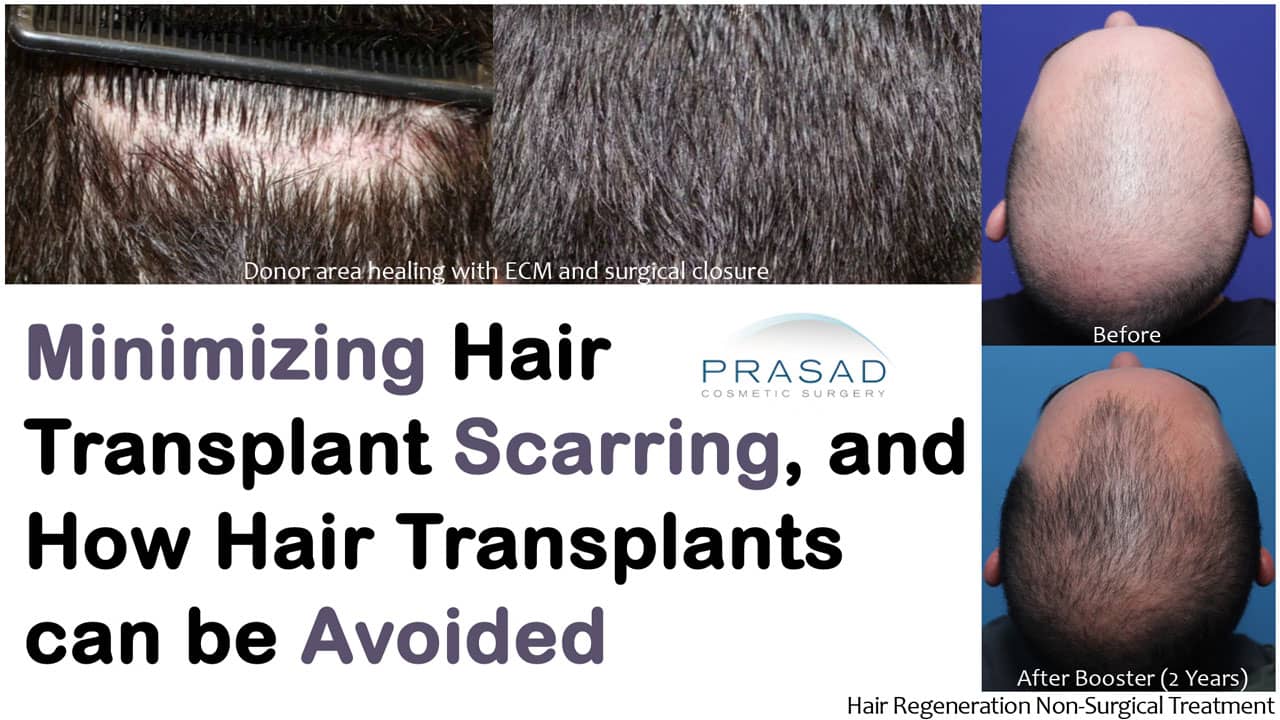 How to Minimize Hair Transplant Scars? - Dr. Amiya Prasad Blog