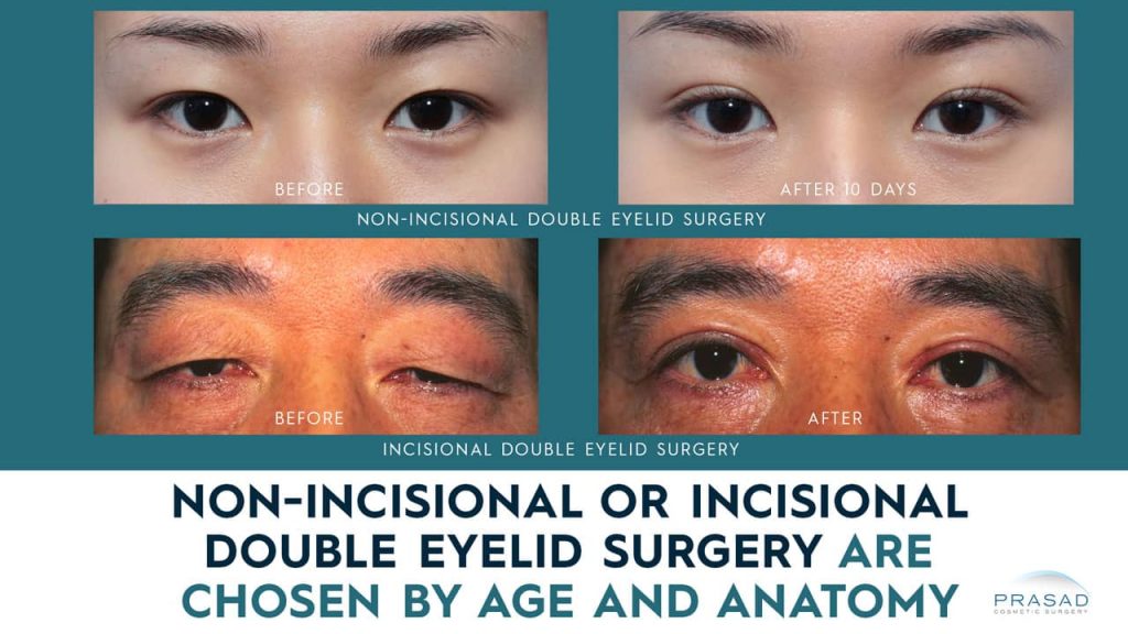 Non-incisional or incisional double eyelid surgery are chosen by age and anatomy