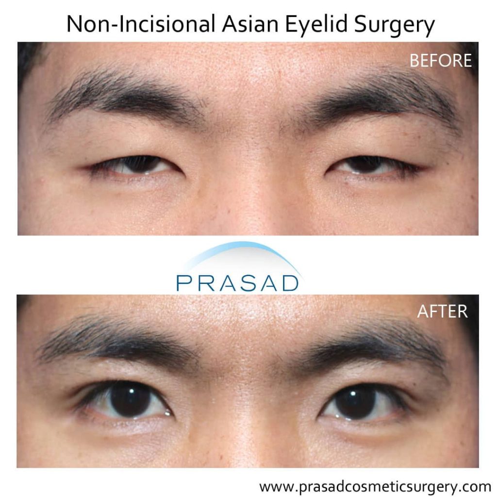 non-incisional double eyelid surgery before and after