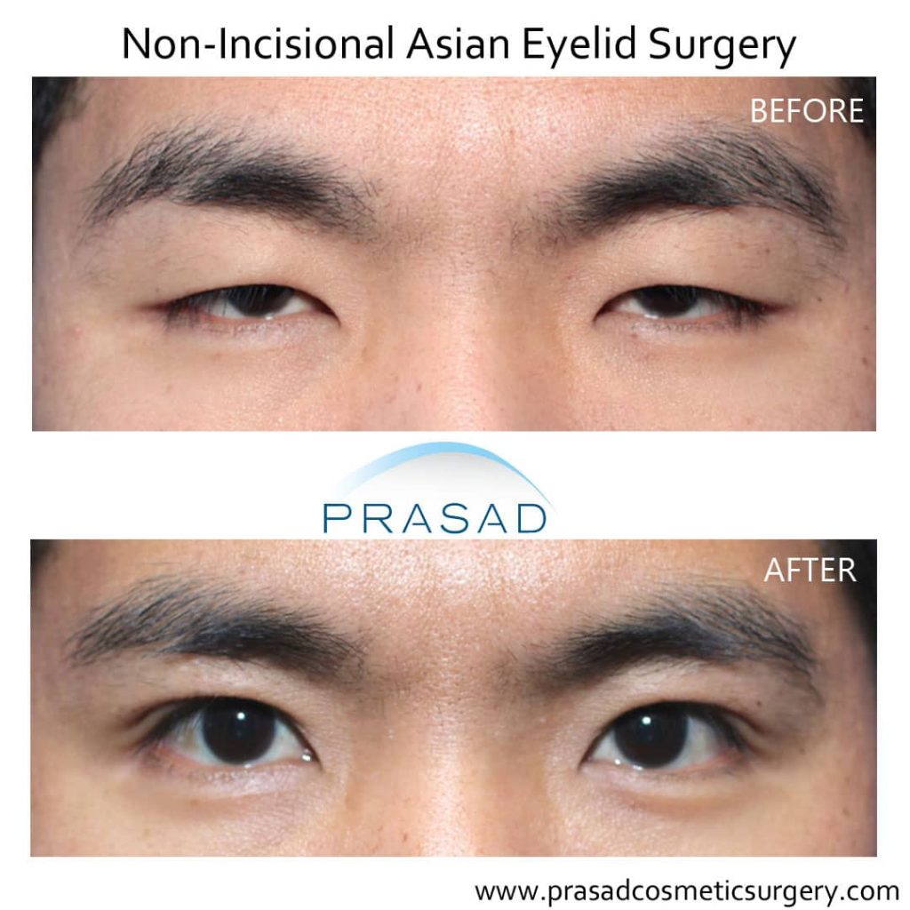 How is a Double Eyelid/ Eyelid Crease Created? Dr. Prasad Blog