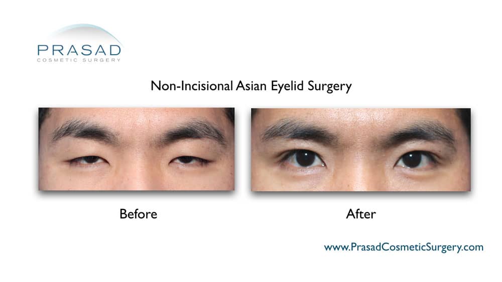 non-incisional asian eyelid surgery before and after full recovery male
