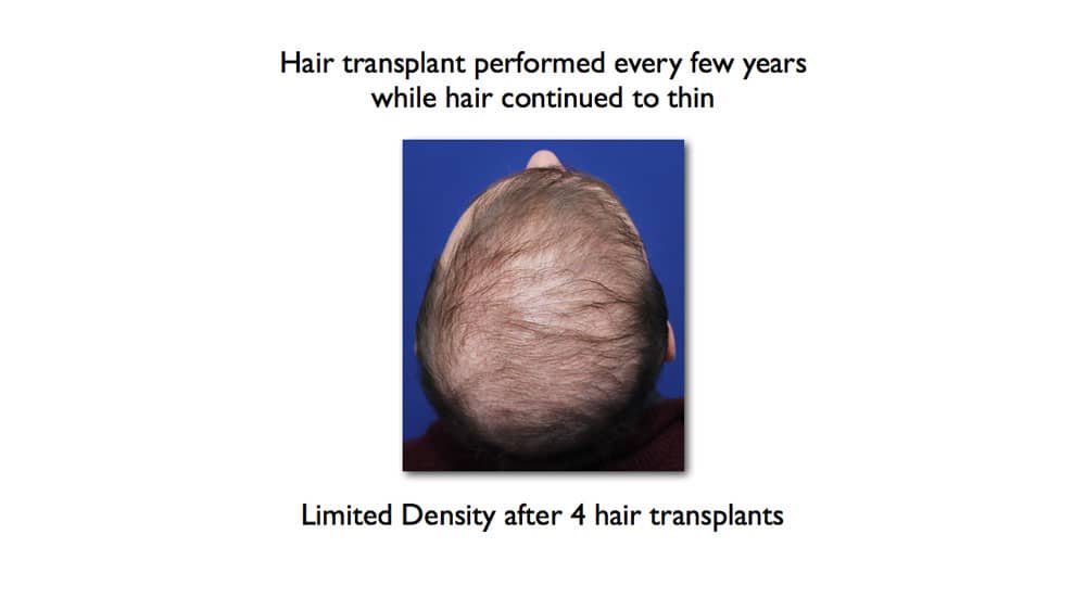 poor density FUT Hair transplant results