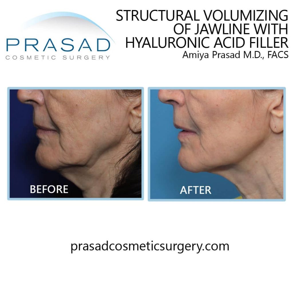 non-surgical facelift before and after