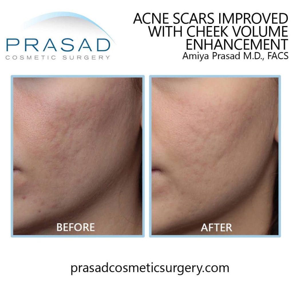 acne scar treatment before and after at Prasad Cosmetic Surgery Manhattan, New York City