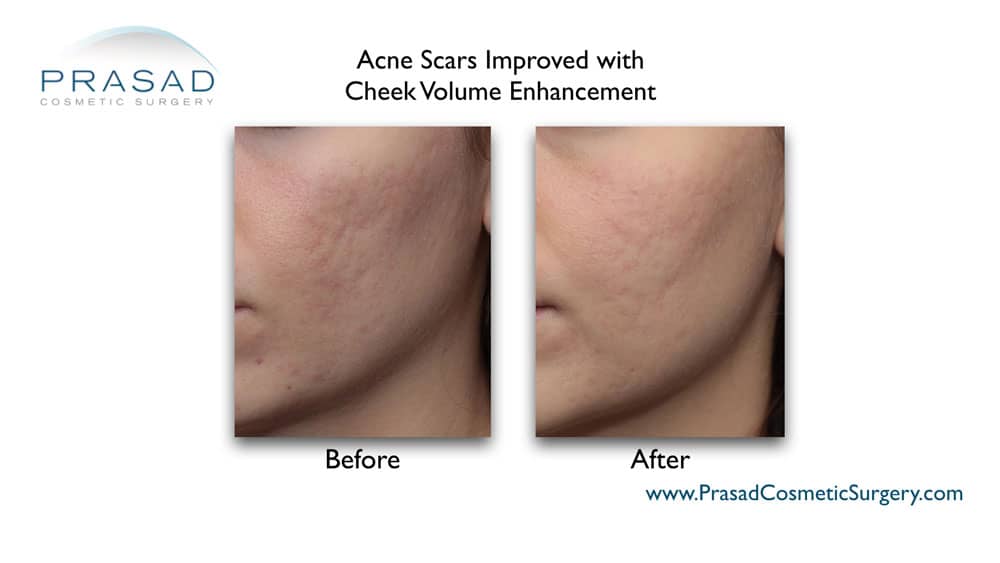acne scar treatment before and after at Prasad Cosmetic Surgery NYC