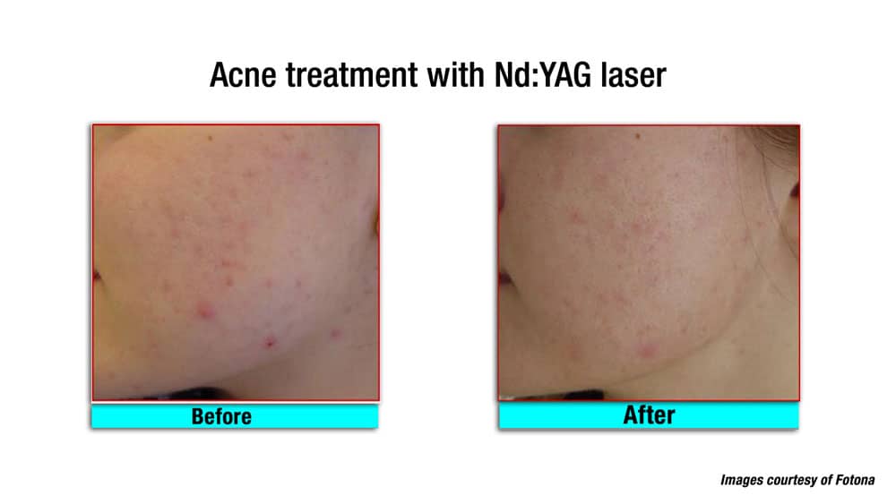 Laser for Acne Scars before and after