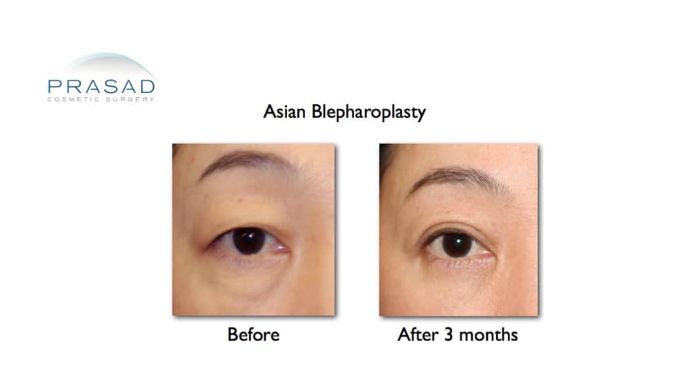 Asian blepharoplasty recovery after 3 months