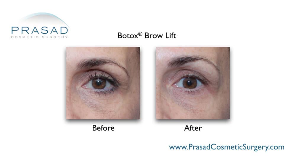 botox brow lift before and after by Dr. Prasad Garden City, Long Island