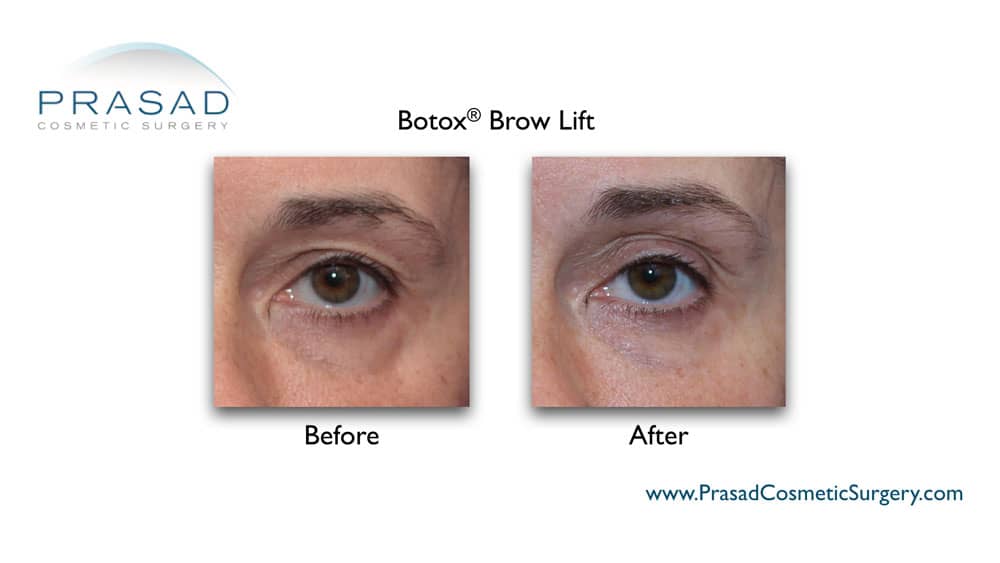 botox brow lift before and after by Dr. Prasad Long Island, New York