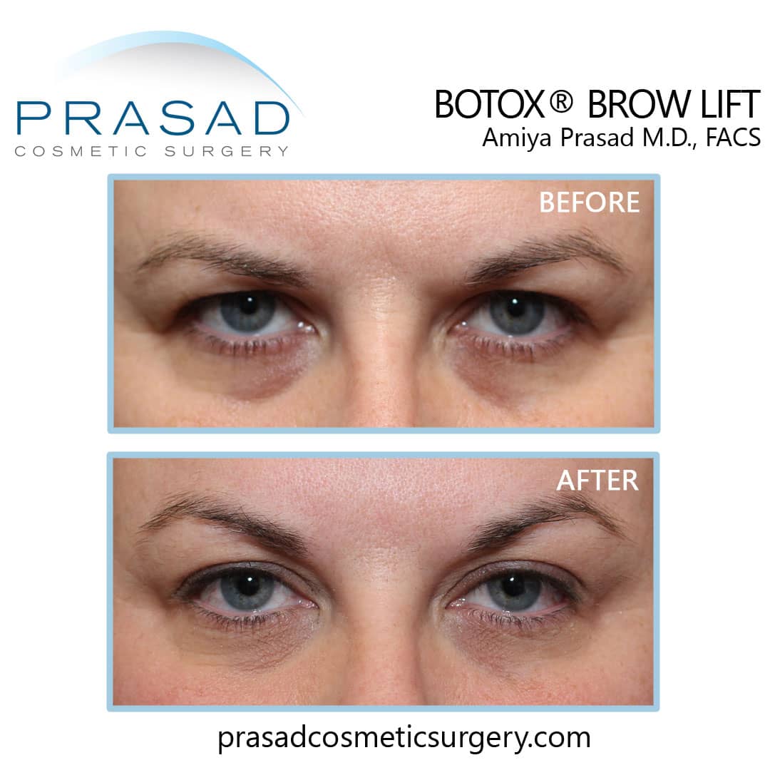 botox brow lift hooded eyes before and after