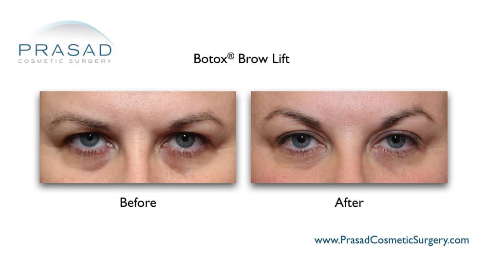 botox brow lift before and after by Dr. Prasad Manhattan NYC