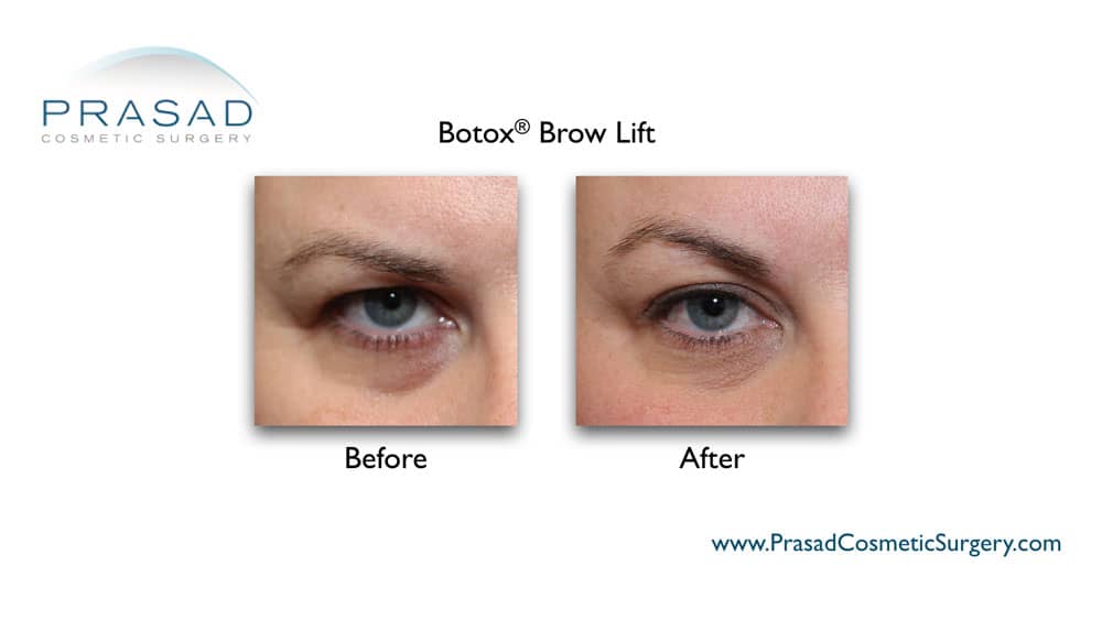 botox brow lift before and after Manhattan NYC