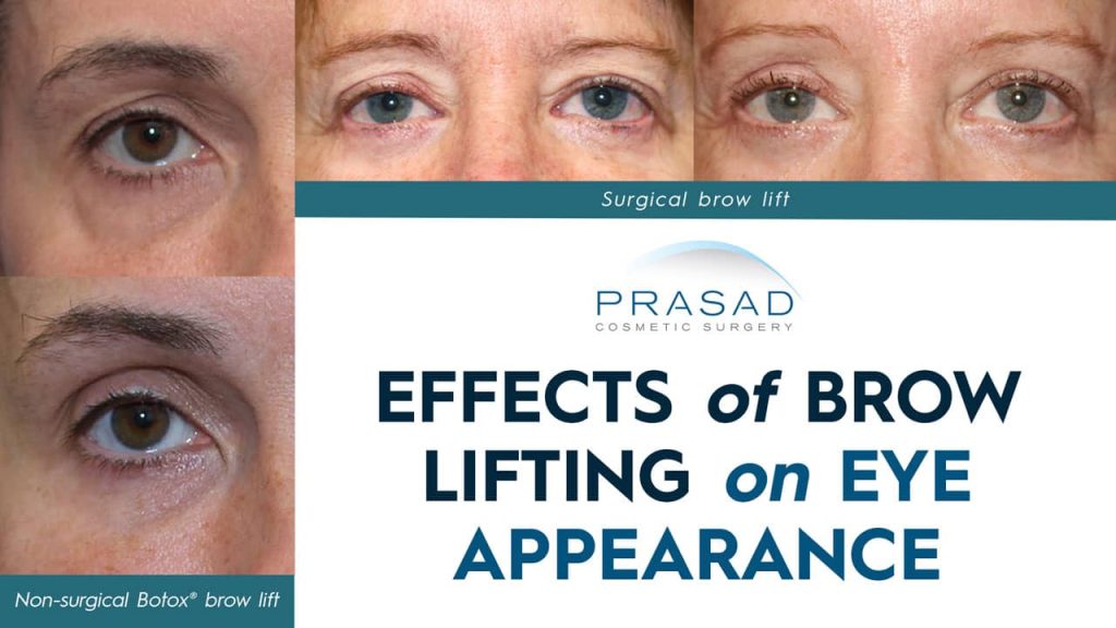 effects of brow lifting on eye appearance