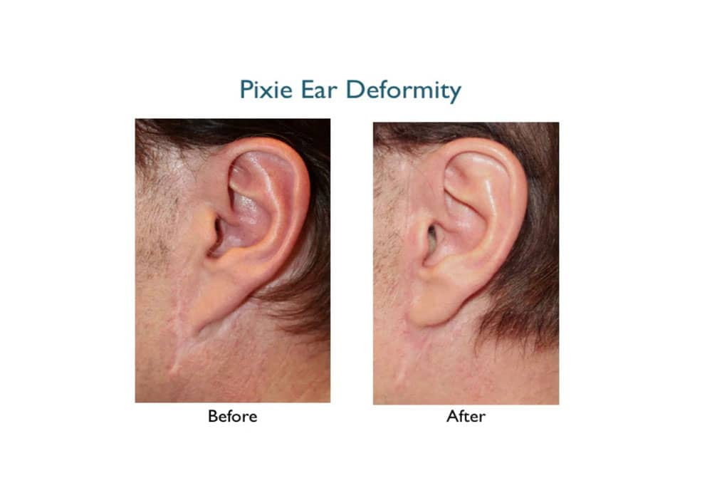 pixie ear deformity facelift before and after