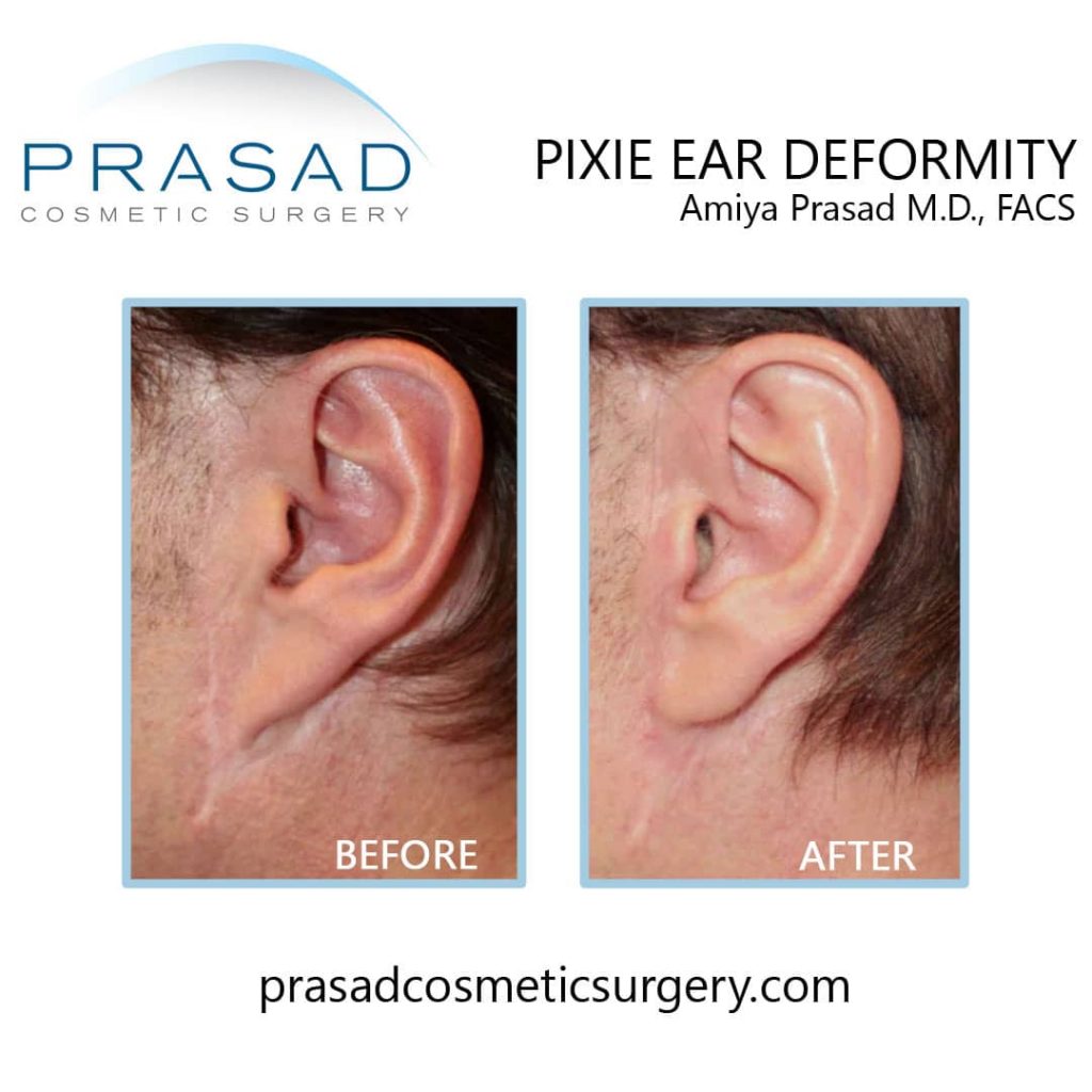 pixie ear deformity before and after