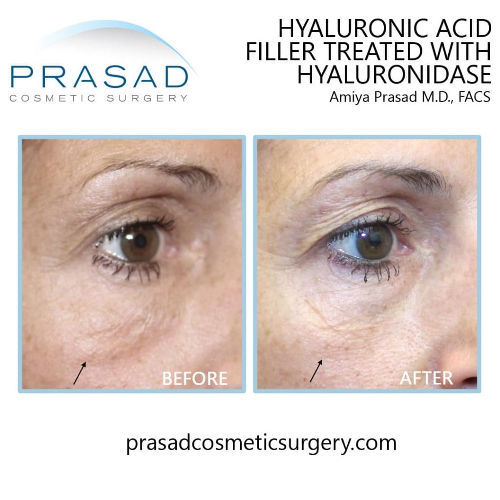 restylane gone wrong treated with hyaluronidase before and after