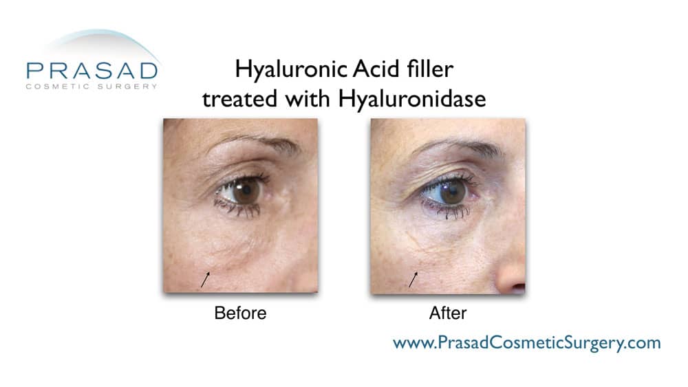 dermal fillers gone wrong treated with hyaluronidase before and after