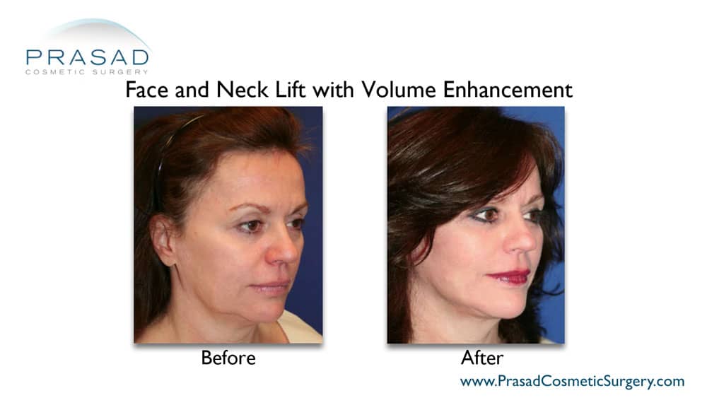 facelift and neck lift before and after