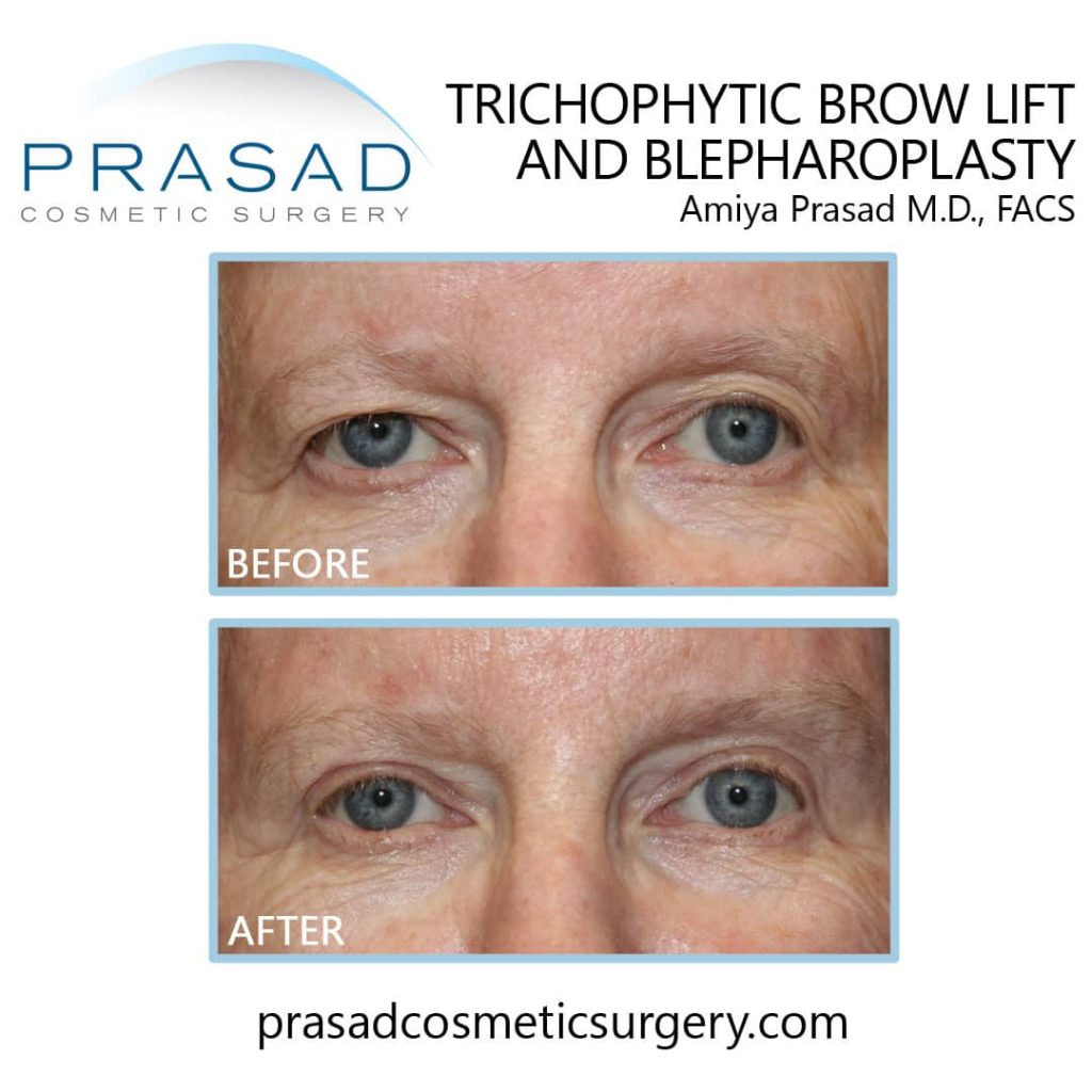 trichophytic brow lift before and after Manhattan NYC