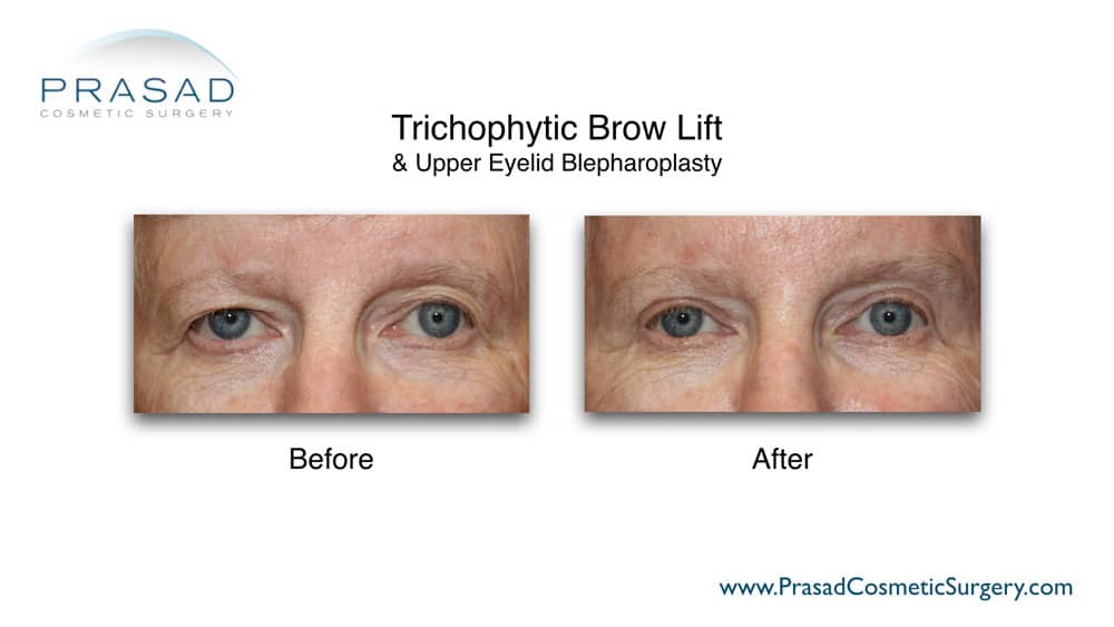 trichophytic brow lift before and after Long Island, NY