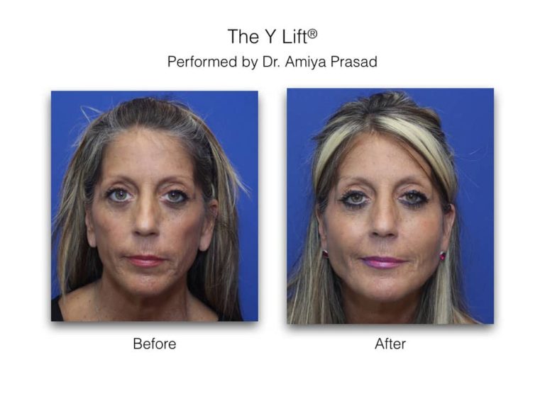 Y Lift Liquid Facelift results can last anywhere between 13 years.