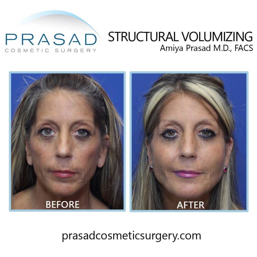 y lift before and after performed by Dr Prasad Manhattan NYC