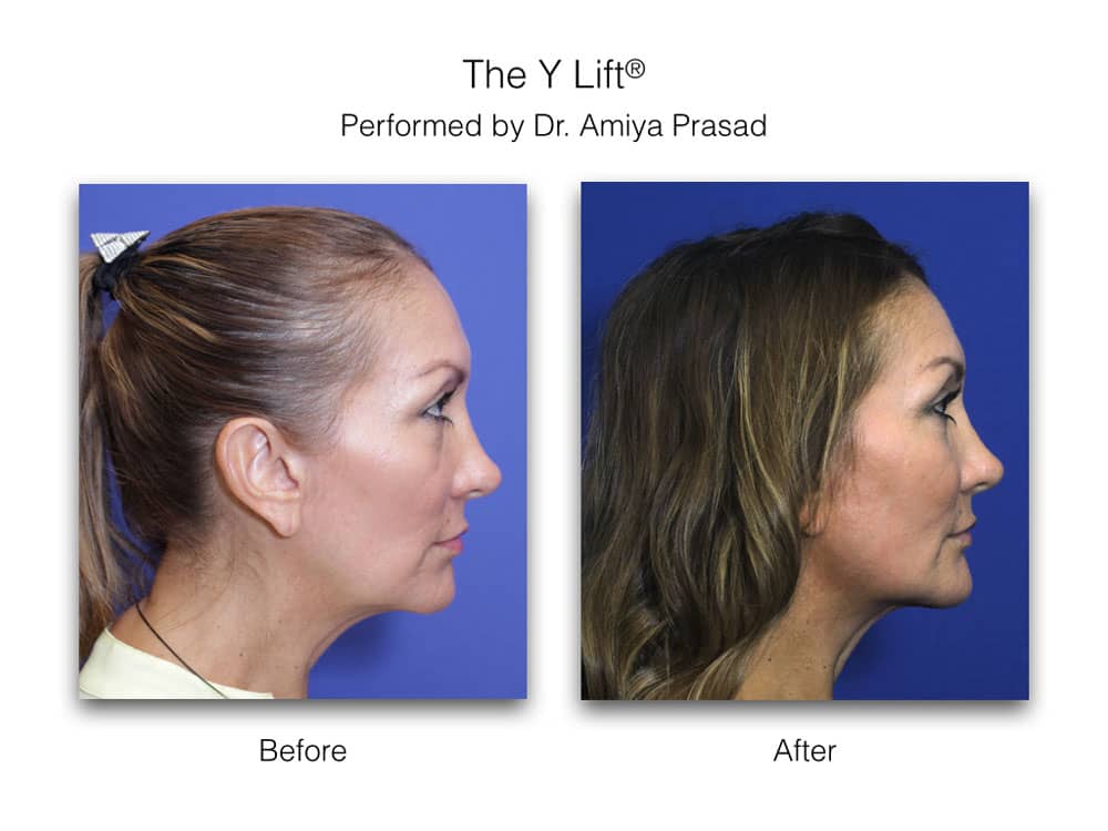 y lift before and after performed by Dr Prasad Garden City New York