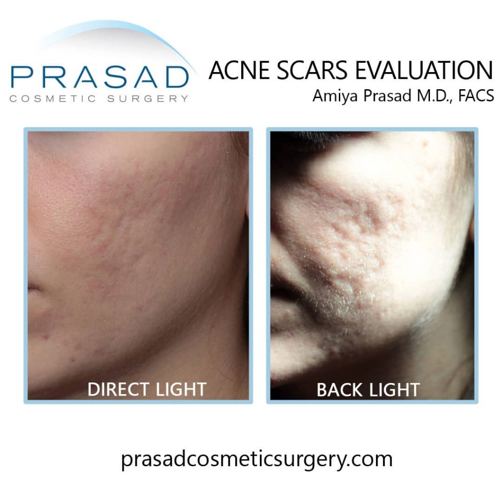 acne scar evaluation