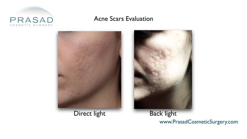 acne scar evaluation at Prasad Cosmetic Surgery NYC and Garden City, New York