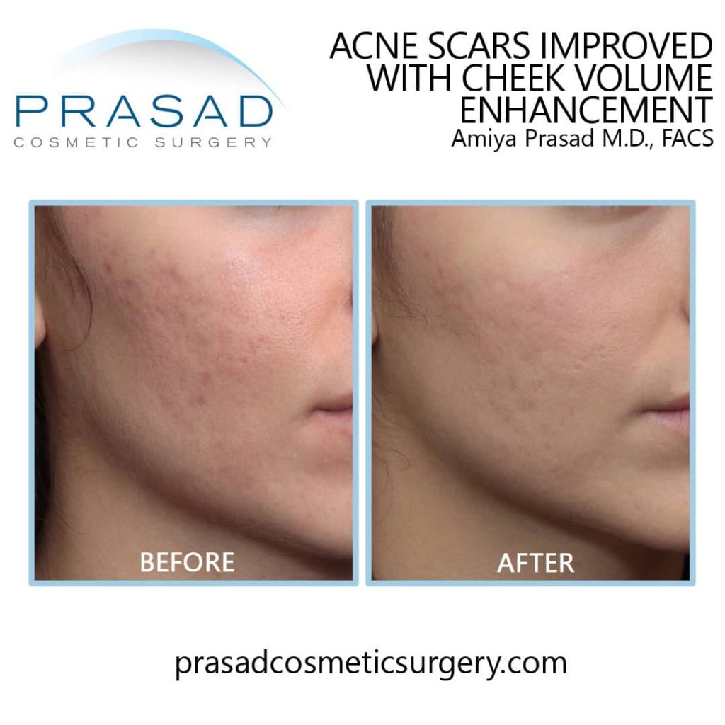 fillers for acne scar before and after treatment