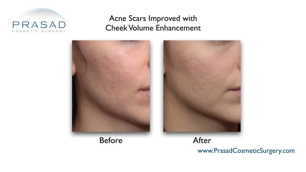 fillers for acne scar before and after treatment at Prasad Cosmetic Surgery New York City, NY