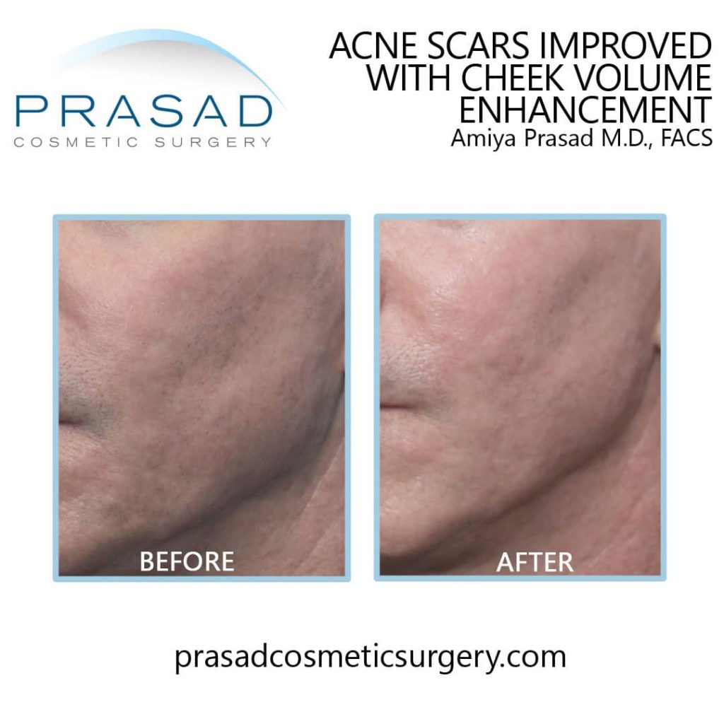 acne scar treatment before and after at Prasad Cosmetic Surgery Garden City, NY