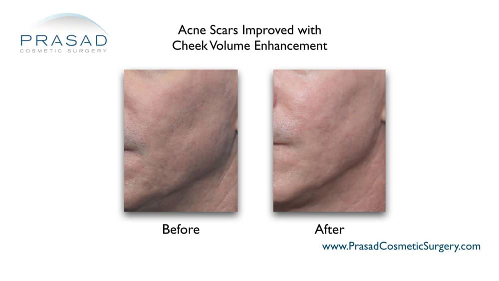 acne scar treatment before and after at Prasad Cosmetic Surgery Long Island, Garden City
