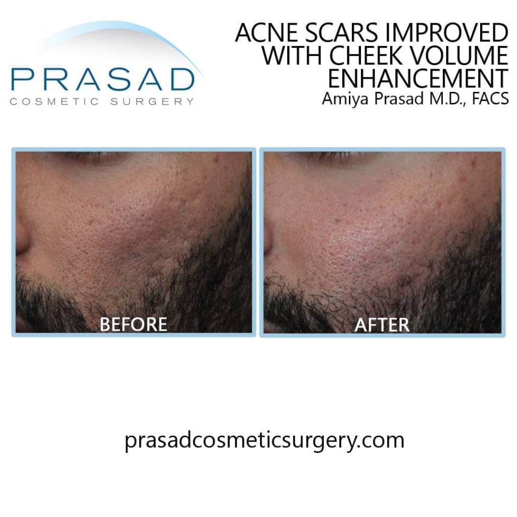 acne scar treatment before and after at Prasad Cosmetic Surgery New York City, NY