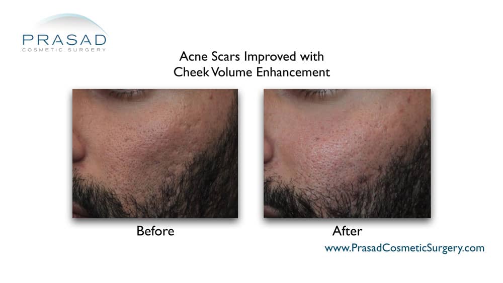 acne scar treatment before and after at Prasad Cosmetic Surgery Garden City, New York