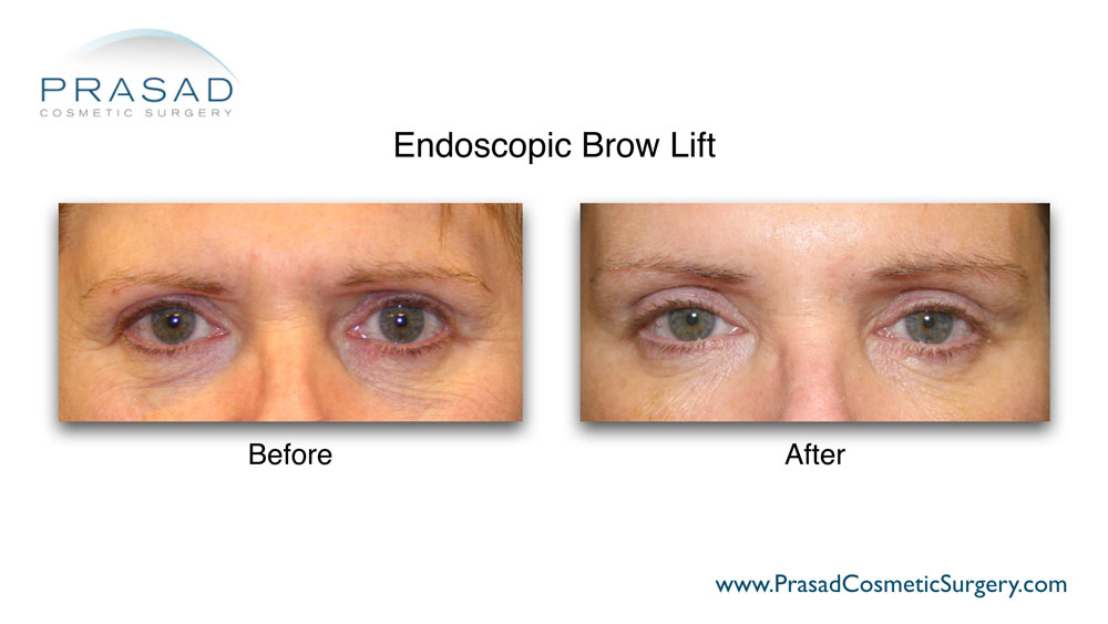 Surgical brow lift before and after Manhattan NYC