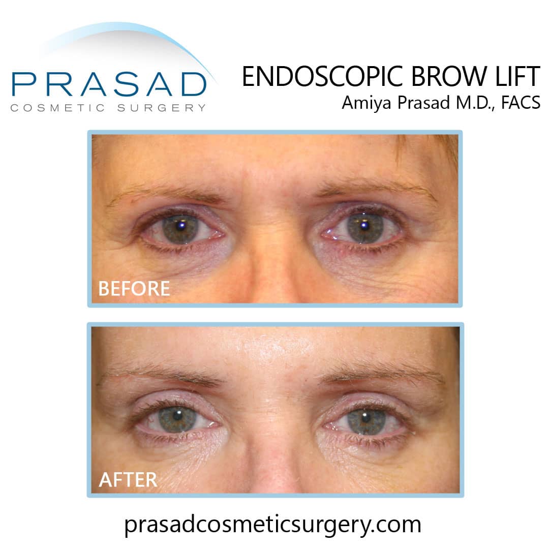 endoscopic brow lift before and after New York