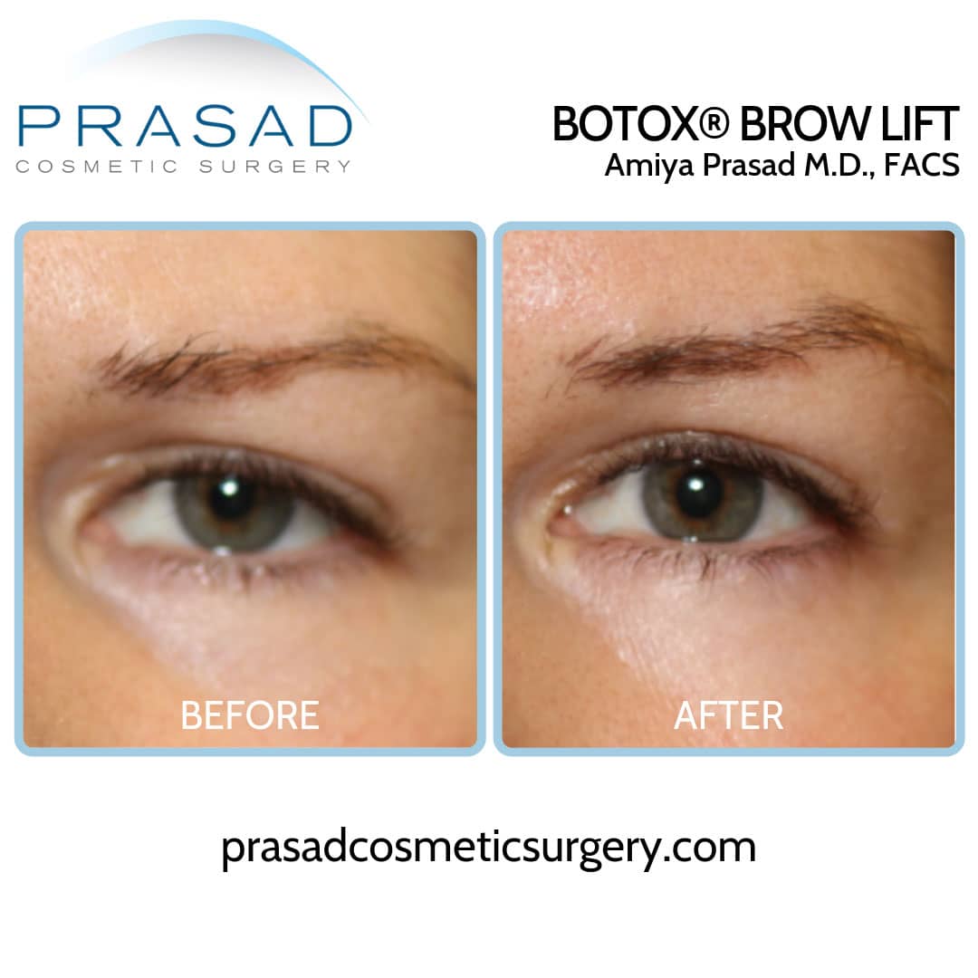 botox brow lift hooded eyes before and after by Dr. Prasad Long Island, New York