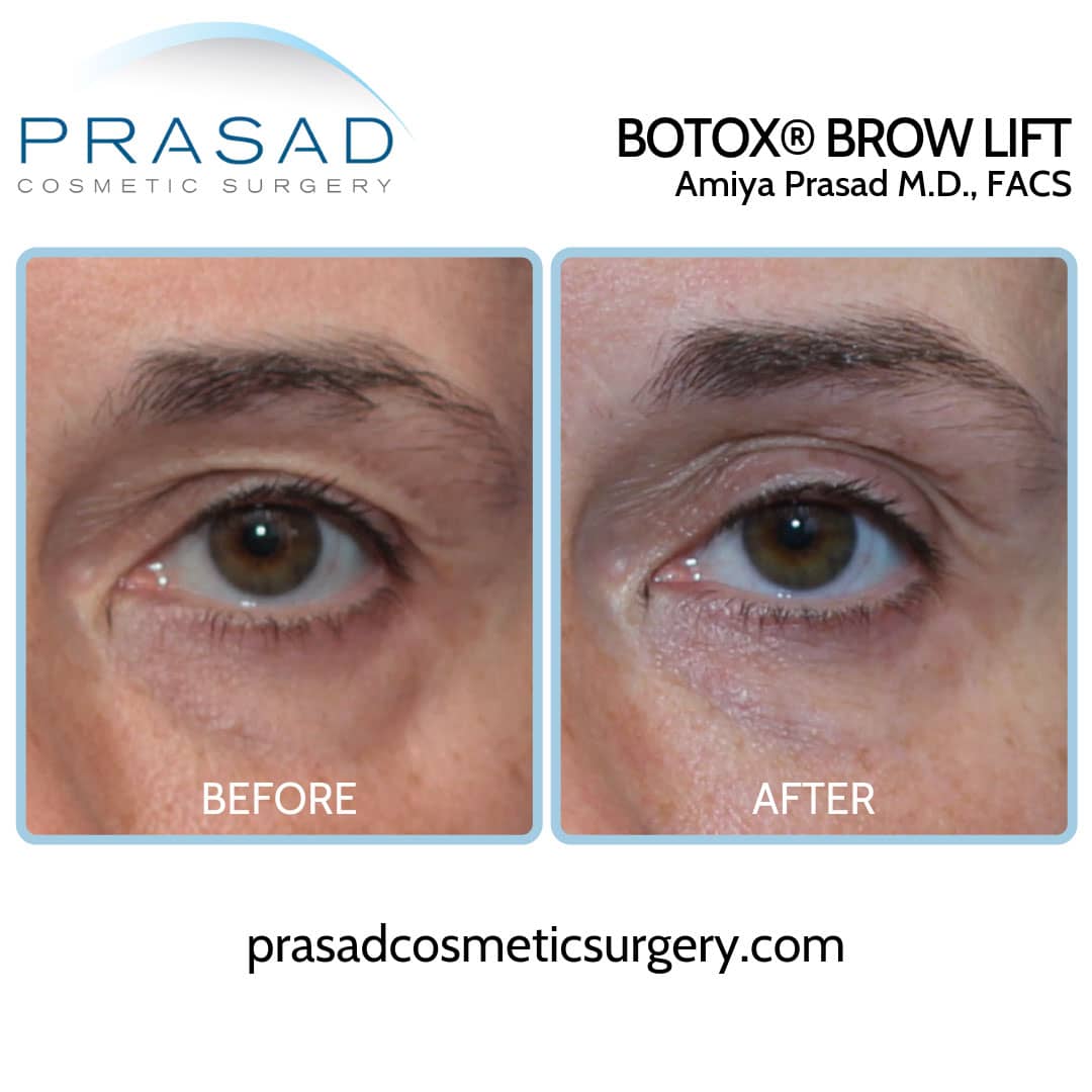 botox brow lift hooded eyes before and after by Dr. Prasad Garden City, Long Island