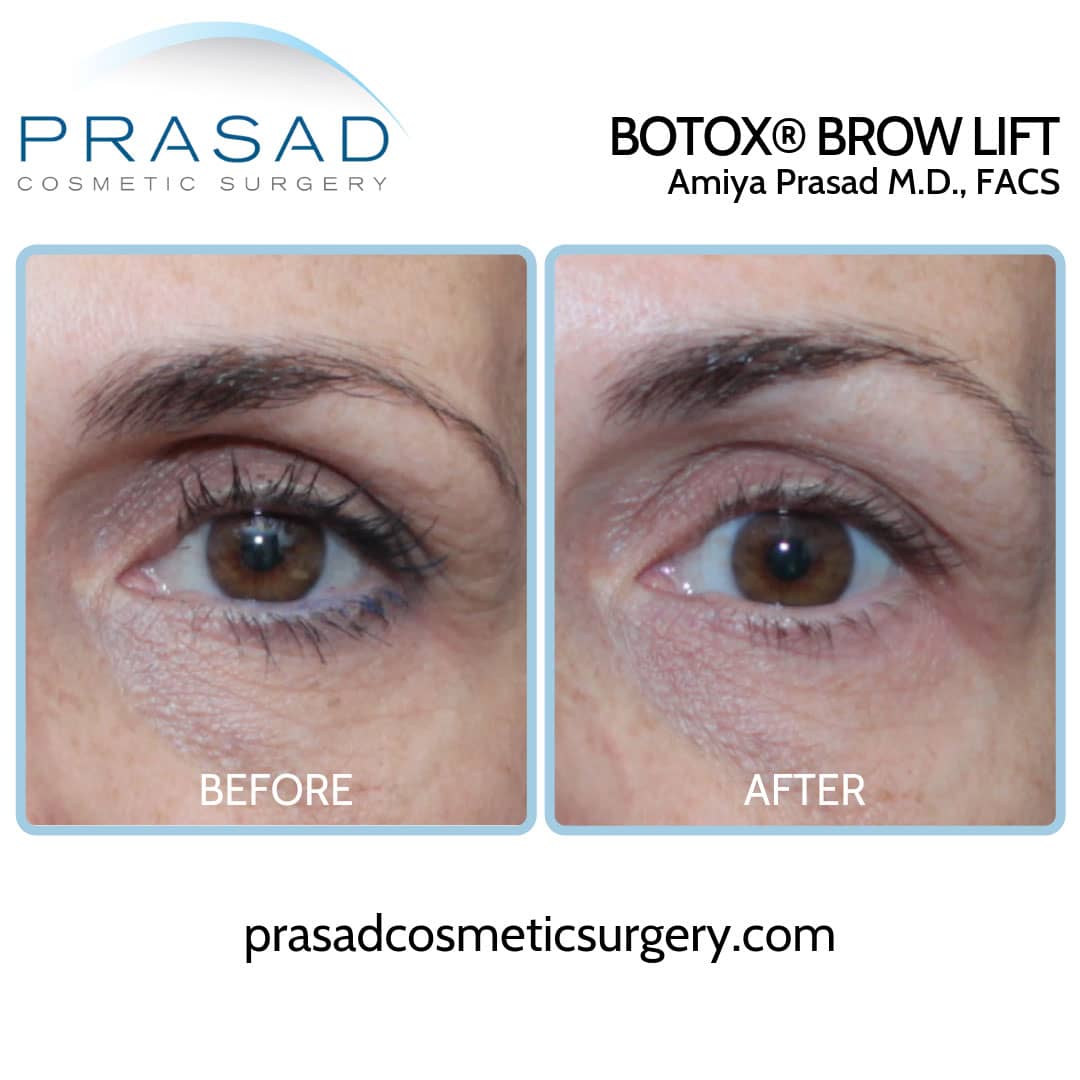botox brow lift hooded eyes before and after by Dr. Prasad Manhattan NYC