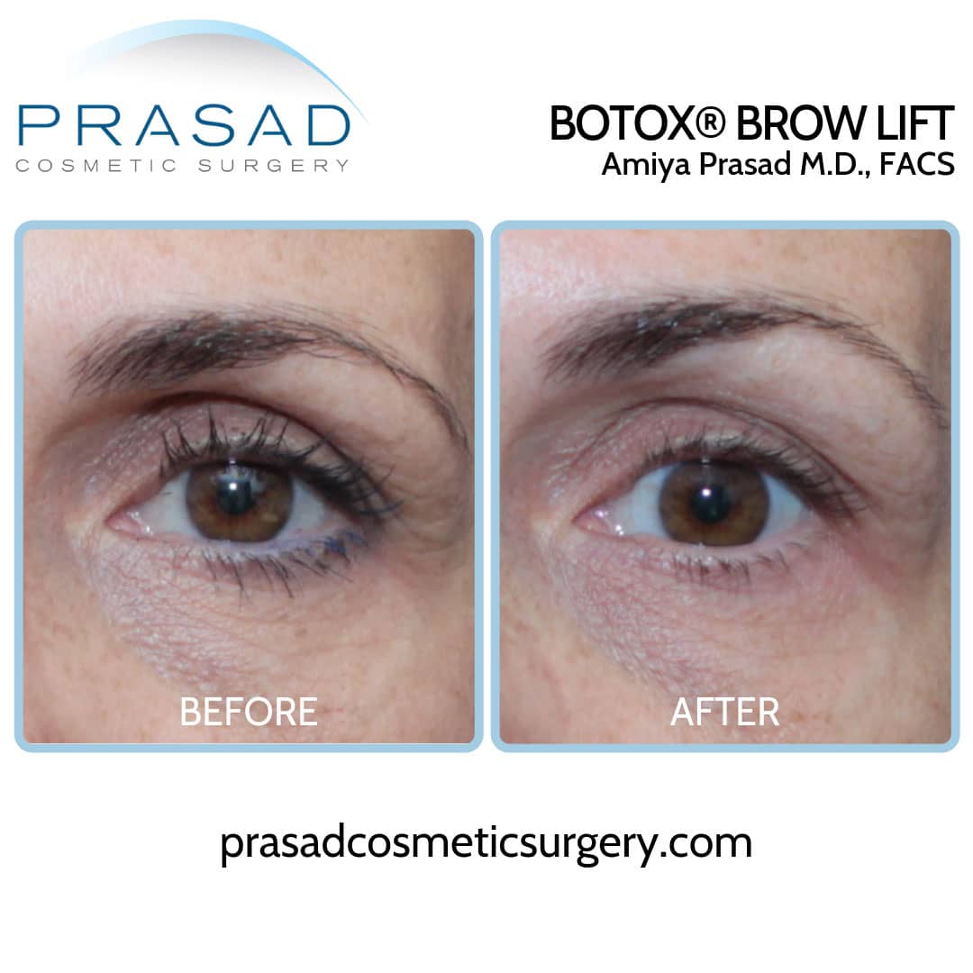 Brow Lift Before and After Photos | Manhattan and Long Island NY