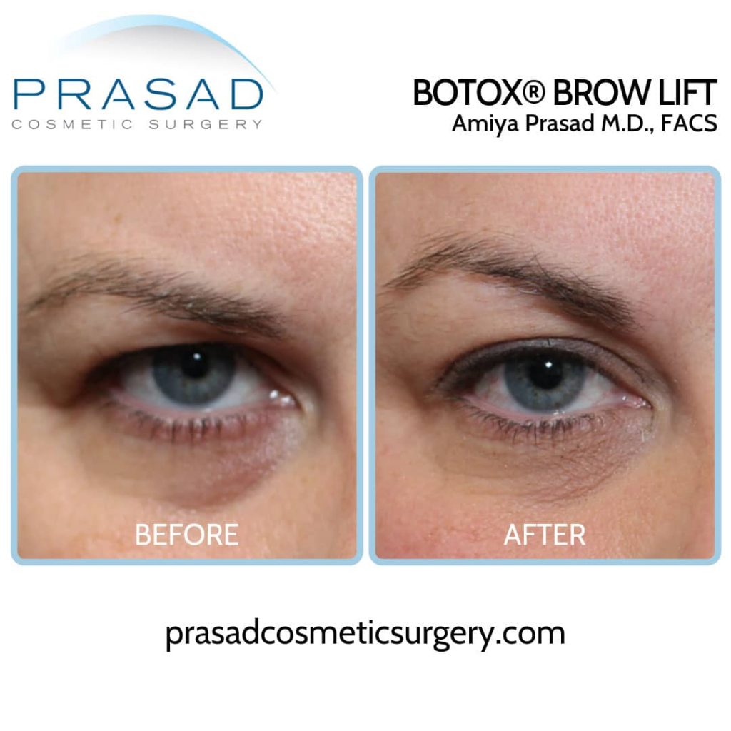 botox brow lift before and after new york city