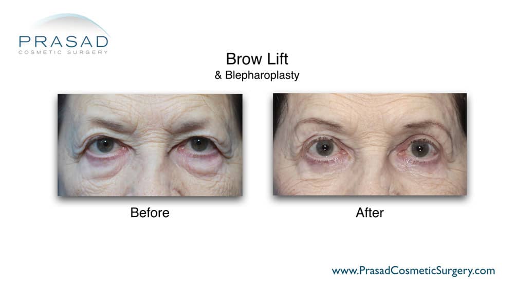 blepharoplasty and brow lift before and after by Dr. Prasad Long Island, NY