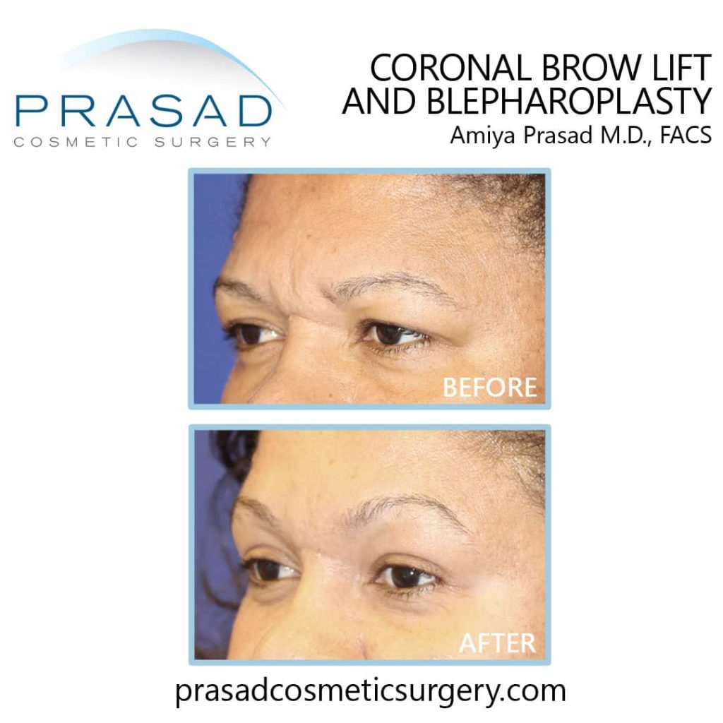 coronal brow lift before and after