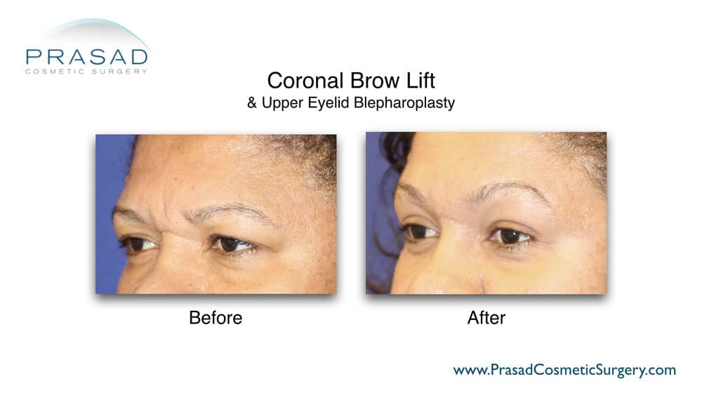 blepharoplasty and brow lift before and after