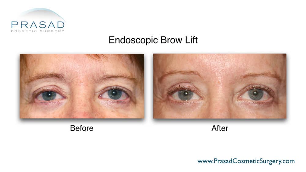 Surgical brow lift before and after Dr. Prasad New York