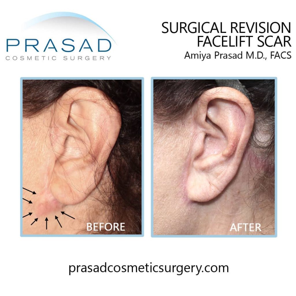 Facelift scar revision before and after