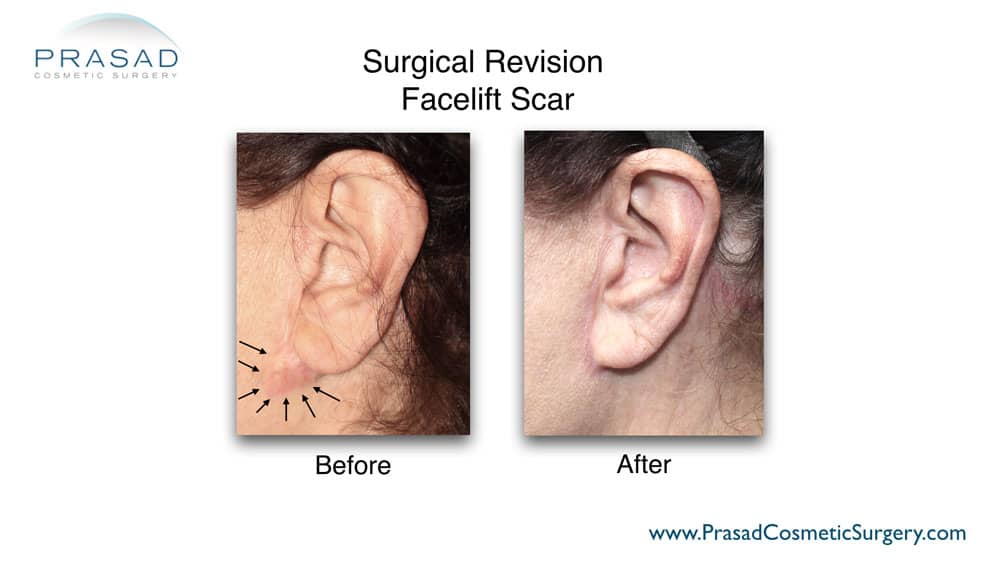 Facelift scar revision before and after procedure done by Dr. Prasad